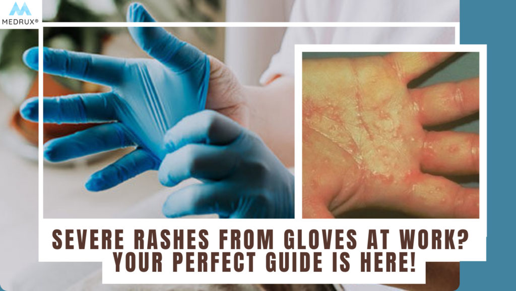 How Can You Tell if You're Allergic to Latex Gloves? – GloveNation